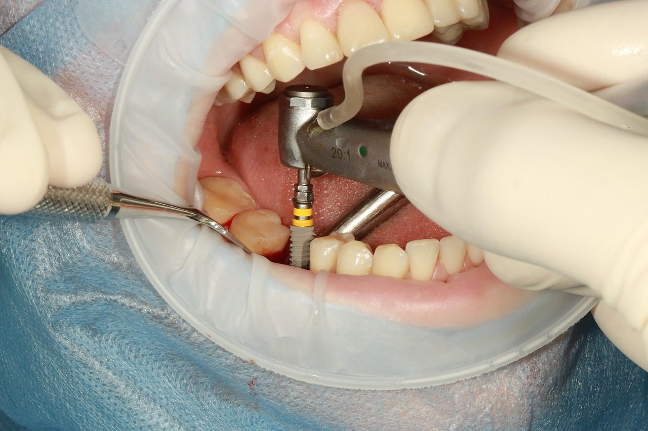 Stock photo: a dental implant being placed in the lower jaw